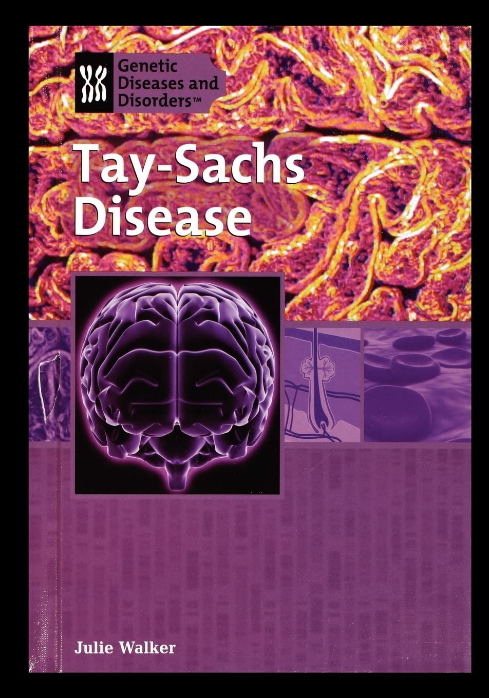 Tay-Sachs Disease